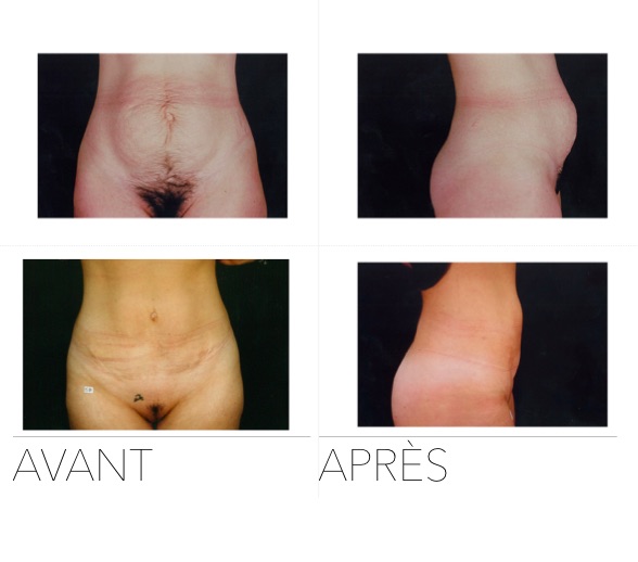 Monsplasty (Liposuction Mons Pubis) - Dr. Teanoosh Zadeh - Clinique T  Montreal
