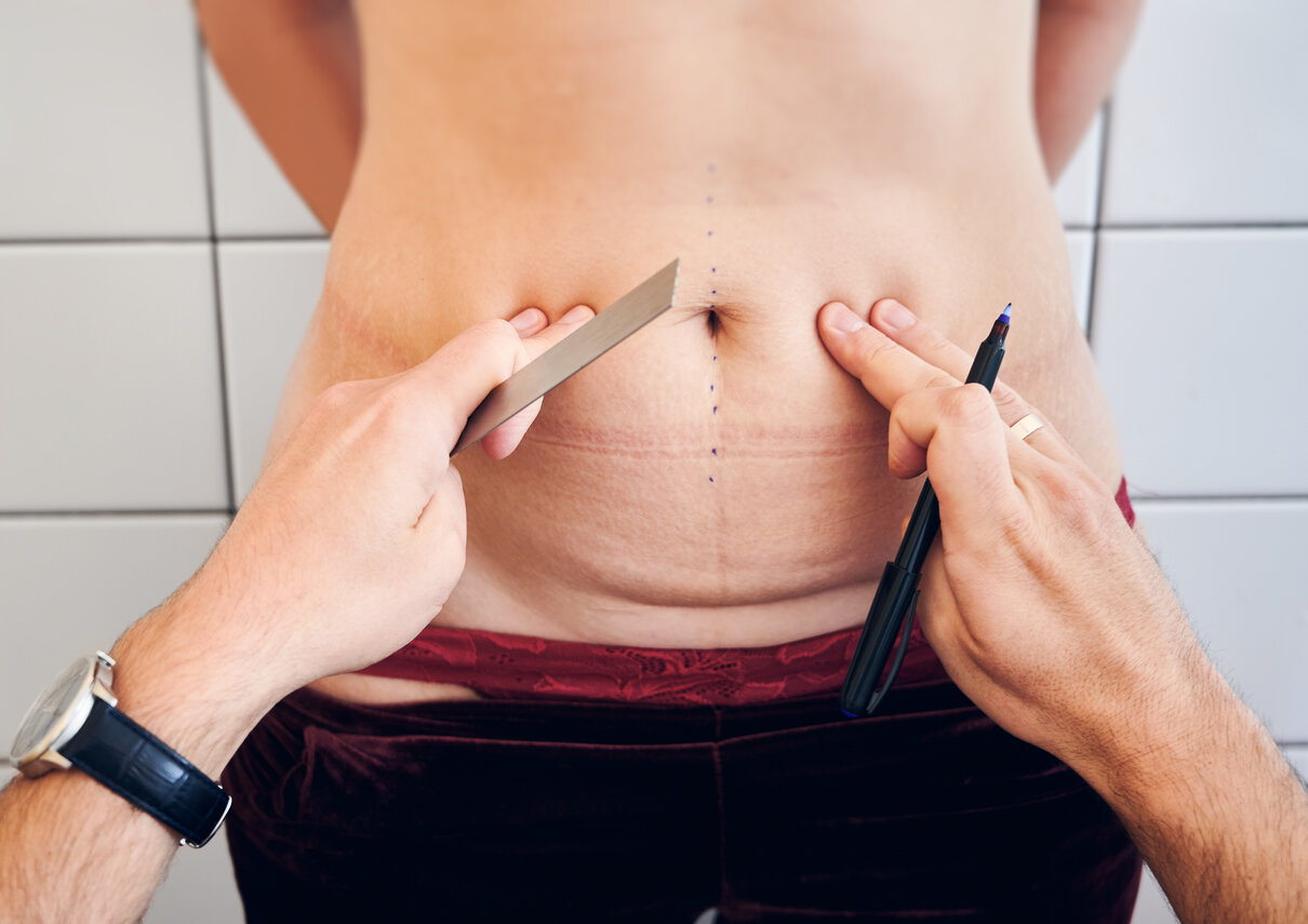Life After Liposuction: Everything You Need to Know!